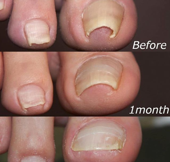 CozyCazza™ Nail Correction Patches